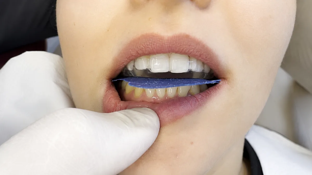 Ajuste da placa oclusal em boca com carbono